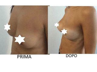 Mastoplastica additiva prima e dopo
