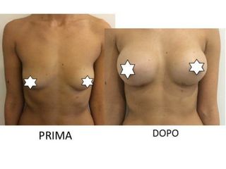 Mastoplastica additiva prima e dopo