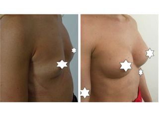 Mastoplastica additiva prima e dopo
