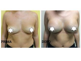 Mastoplastica additiva prima e dopo