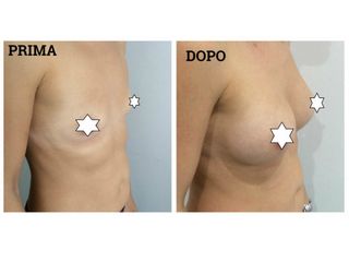 Mastoplastica additiva prima e dopo