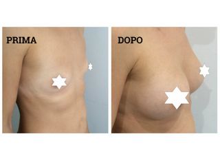 Mastoplastica additiva prima e dopo