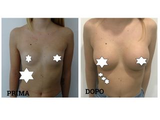 Mastoplastica additiva prima e dopo
