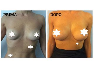 Mastoplastica additiva prima e dopo