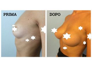 Mastoplastica additiva prima e dopo