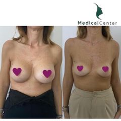 Mastoplastica additiva - Medical Center Chirurgia Plastica - Cagliari