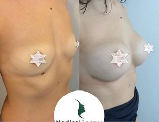 Medical Center Chirurgia Plastica - Cagliari Mastoplastica additiva