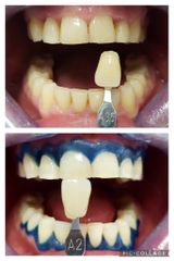 Sbiancamento dentale - Dr. Antonio Scerra
