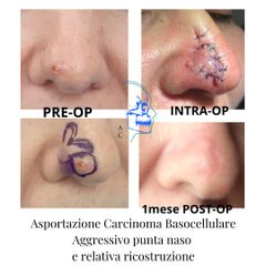 Asportazione Carcinoma Basocellulare Aggressivo punta naso e relativa ricostruzione.png