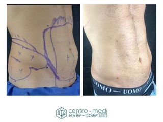 Liposcultura laser prima e dopo