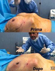 Liposuzione - Dott. Giovanni Gallo