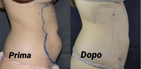 Liposuzione - Dott. Giovanni Gallo