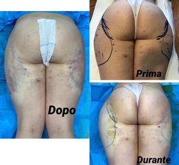 Liposuzione - Dott. Giovanni Gallo