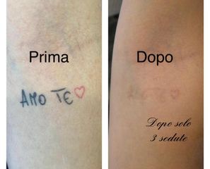 Rimozione tatuaggi - Dott. Giovanni Gallo