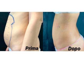 Liposcultura laser - Dott. Giovanni Gallo