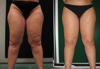 Liposcultura prima e dopo