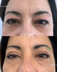 Dr. Stefano Chiummariello Blefaroplastica