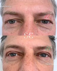 Dr. Stefano Chiummariello Blefaroplastica