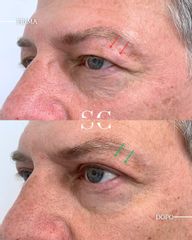 Dr. Stefano Chiummariello Blefaroplastica