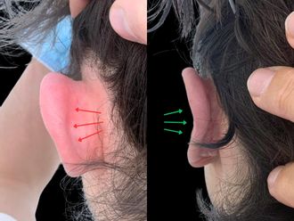 Otoplastica prima e dopo - 879067