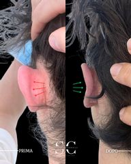 Dr. Stefano Chiummariello Otoplastica