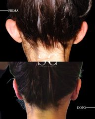 Dr. Stefano Chiummariello Otoplastica