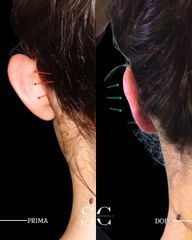 Dr. Stefano Chiummariello Otoplastica