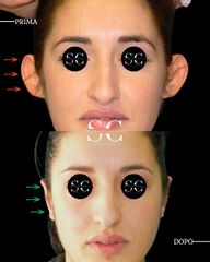 Dr. Stefano Chiummariello Otoplastica