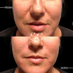 Dr. Stefano Chiummariello Filler