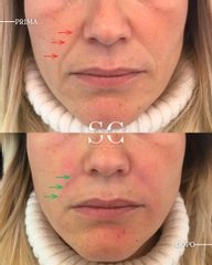 Dr. Stefano Chiummariello Filler (2)