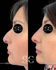 Dr. Stefano Chiummariello Rinofiller