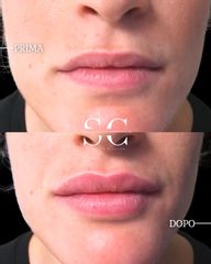 Dr. Stefano Chiummariello Filler labbra