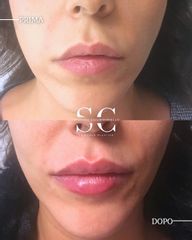 Dr. Stefano Chiummariello Filler labbra