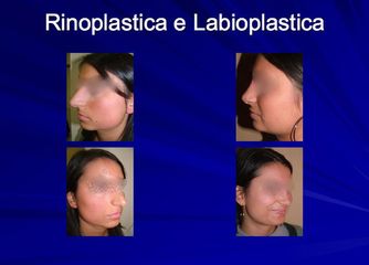 rinoplastica prima dopo