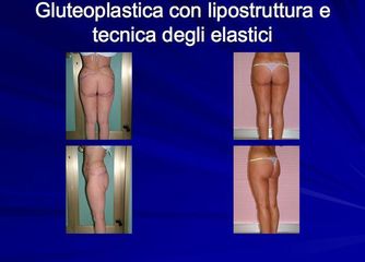 Gluteoplastica prima dopo