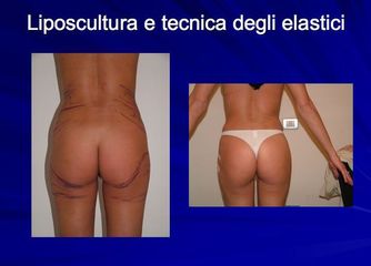 Liposcultura prima dopo