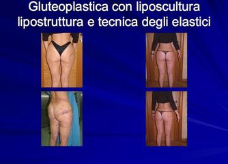 Gluteoplastica prima dopo