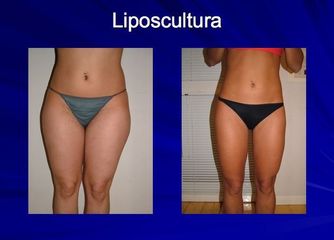 liposcultura prima dopo