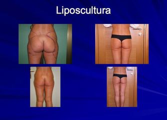 liposcultura prima dopo