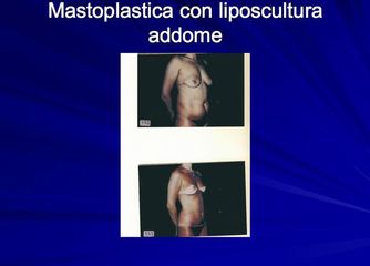 mastoplastica prima dopo