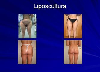 liposcultura prima dopo