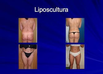 liposcultura prima dopo