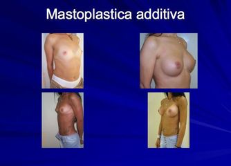 mastoplastica additiva prima dopo