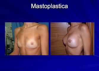 mastoplastica additiva prima dopo