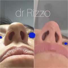 Rinofiller - Dott. Arnaldo Rizzo