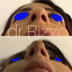 Rinofiller - Dott. Arnaldo Rizzo
