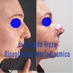 Rinoplastica - Dott. Arnaldo Rizzo