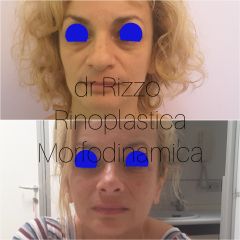 Rinoplastica - Dott. Arnaldo Rizzo