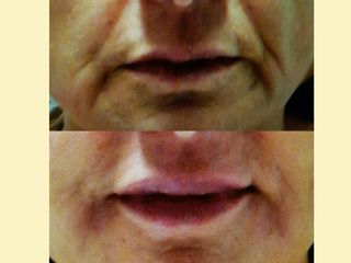 Filler labbra con acido ialuronico