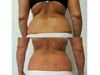 Lipolaser prima e dopo
